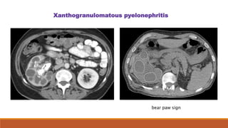 Xanthogranulomatous pyelonephritis
bear paw sign
 