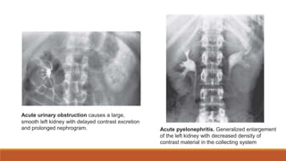 Acute urinary obstruction causes a large,
smooth left kidney with delayed contrast excretion
and prolonged nephrogram. Acute pyelonephritis. Generalized enlargement
of the left kidney with decreased density of
contrast material in the collecting system
 