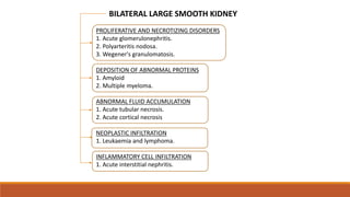 PROLIFERATIVE AND NECROTIZING DISORDERS
1. Acute glomerulonephritis.
2. Polyarteritis nodosa.
3. Wegener's granulomatosis.
DEPOSITION OF ABNORMAL PROTEINS
1. Amyloid
2. Multiple myeloma.
ABNORMAL FLUID ACCUMULATION
1. Acute tubular necrosis.
2. Acute cortical necrosis
NEOPLASTIC INFILTRATION
1. Leukaemia and lymphoma.
INFLAMMATORY CELL INFILTRATION
1. Acute interstitial nephritis.
BILATERAL LARGE SMOOTH KIDNEY
 