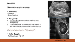  Ultrasonographic Findings
 Morphology
- Enlarged
- Smooth outline
 Echogenicity
1. Ischemic ATN- Normal cortical and medullary
echogenicity
2. Drug related ATN- increased cortical echogenicity
and maintained corticomedullary differentiation
○ Perirenal hypoechoic rim ("kidney sweat")
 Color Doppler
- Resistive index: ↑ (> 0.7)
IMAGING
"kidney sweat“ sign
 