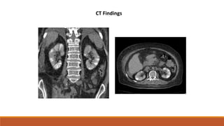 CT Findings
 