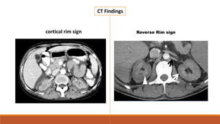 CT Findings
cortical rim sign Reverse Rim sign
 