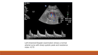 Left intrarenal Doppler examination shows a normal
arterial curve with sharp systolic peak and resistance
index <0.70
 