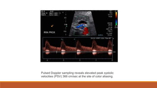 Pulsed Doppler sampling reveals elevated peak systolic
velocities (PSV) 366 cm/sec at the site of color aliasing.
 