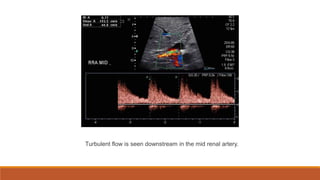 Turbulent flow is seen downstream in the mid renal artery.
 