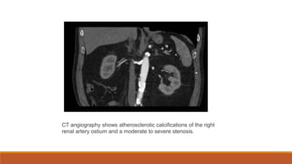 CT angiography shows atherosclerotic calcifications of the right
renal artery ostium and a moderate to severe stenosis.
 