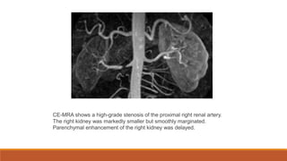 CE-MRA shows a high-grade stenosis of the proximal right renal artery.
The right kidney was markedly smaller but smoothly marginated.
Parenchymal enhancement of the right kidney was delayed.
 