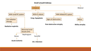Small smooth kidneys
Unilateral Bilateral
With small PC system With<5 calyces With dilated PC system
Cong. hypoplasia
H/o radiation
therapy
Radiation nephritis
Abnormal renal
Vessels (Art)
Dense Faint/Nil
Acute ischemia
Signs of obstruction
Post obstructive atrophy
Reflux
Reflux atrophy
Chr. infarction
Nephrogram
 