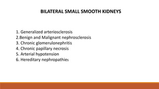 1. Generalized arteriosclerosis
2.Benign and Malignant nephrosclerosis
3. Chronic glomerulonephritis
4. Chronic papillary necrosis
5. Arterial hypotension
6. Hereditary nephropathies
BILATERAL SMALL SMOOTH KIDNEYS
 