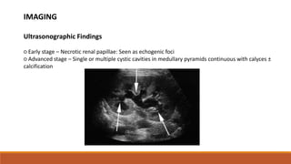 IMAGING
Ultrasonographic Findings
○ Early stage – Necrotic renal papillae: Seen as echogenic foci
○ Advanced stage – Single or multiple cystic cavities in medullary pyramids continuous with calyces ±
calcification
 