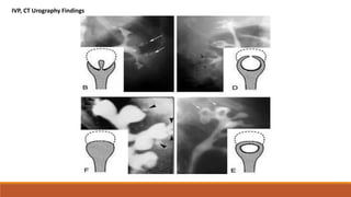 IVP, CT Urography Findings
 
