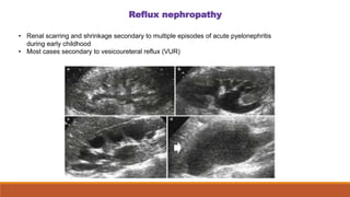 Reflux nephropathy
• Renal scarring and shrinkage secondary to multiple episodes of acute pyelonephritis
during early childhood
• Most cases secondary to vesicoureteral reflux (VUR)
 
