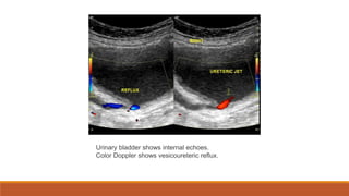 Urinary bladder shows internal echoes.
Color Doppler shows vesicoureteric reflux.
 