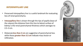 • Preserved interpapillary line is a useful landmark for evaluating
loss of renal parenchyma.
• Interpapillary line is drawn through the tips of papilla (base of
the calyces) the distance from this line to lateral surface of
kidney is the renal parenchymal thickness which averages to
2.5–3 cm.
• Distances less than 2 cm are suggestive of parenchymal loss
while those greater than 3.5 cm indicate mass lesion or
infiltration.
INTERPAPPILARY LINE
 