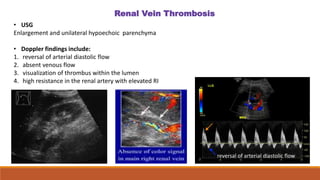 Renal Vein Thrombosis
• USG
Enlargement and unilateral hypoechoic parenchyma
• Doppler findings include:
1. reversal of arterial diastolic flow
2. absent venous flow
3. visualization of thrombus within the lumen
4. high resistance in the renal artery with elevated RI
reversal of arterial diastolic flow
 