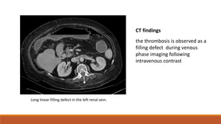 the thrombosis is observed as a
filling defect during venous
phase imaging following
intravenous contrast
Long linear filling defect in the left renal vein.
CT findings
 