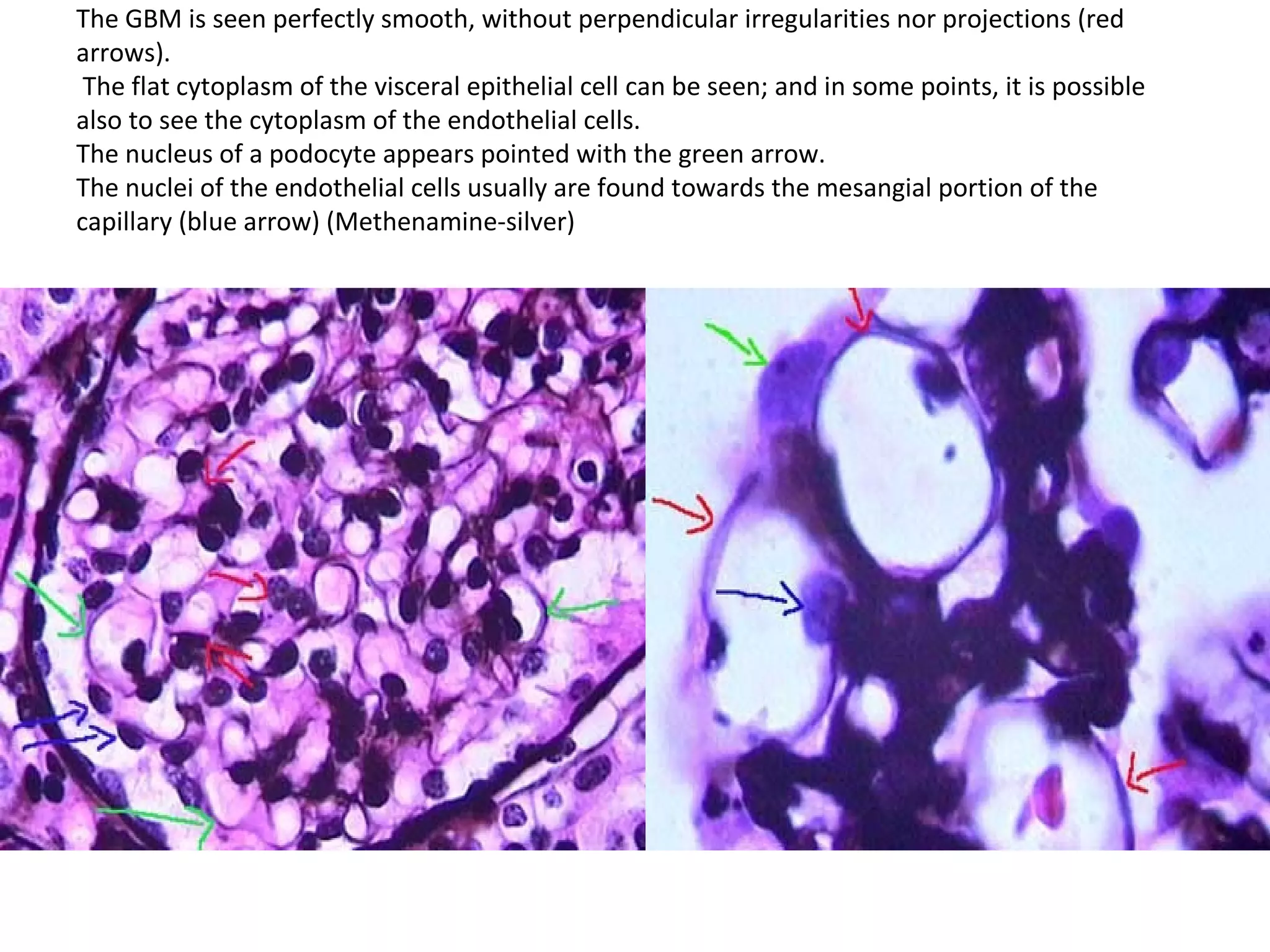 The GBM is seen perfectly smooth, without perpendicular irregularities nor projections (red arrows).  The flat cytoplasm of the visceral epithelial cell can be seen; and in some points, it is possible also to see the cytoplasm of the endothelial cells.  The nucleus of a podocyte appears pointed with the green arrow.  The nuclei of the endothelial cells usually are found towards the mesangial portion of the capillary (blue arrow) (Methenamine-silver) 