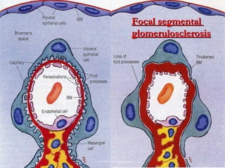 Focal segmental  glomerulosclerosis www.freelivedoctor.com 
