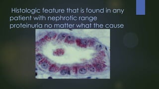 Histologic feature that is found in any
patient with nephrotic range
proteinuria no matter what the cause

 