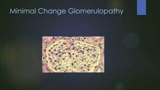 Minimal Change Glomerulopathy

 