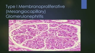 Type I Membranoproliferative
(Mesangiocapillary)
Glomerulonephritis

 