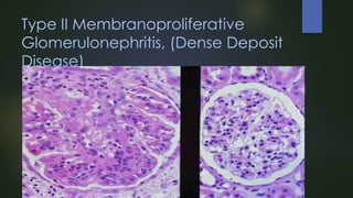 Type II Membranoproliferative
Glomerulonephritis, (Dense Deposit
Disease)

 