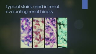 Typical stains used in renal
evaluating renal biopsy

 