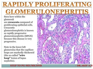 Crescentic Rpgn Renal pathology | PDF