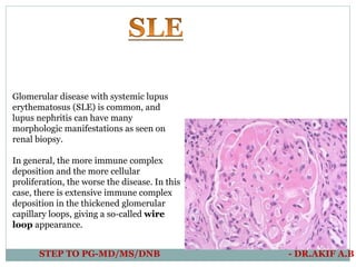 Glomerular disease with systemic lupus
erythematosus (SLE) is common, and
lupus nephritis can have many
morphologic manife...