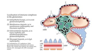 Localization of immune complexes
in the glomerulus:
(1) Subepithelial humps, as in acute
glomerulonephritis;
(2) Membranous deposits, as in
membranous nephropathy and
Heymann nephritis;
(3) Subendothelial deposits, as in
lupus nephritis and
membranoproliferative
glomerulonephritis;
(4) Mesangial deposits, as in IgA
nephropathy.
EN, Endothelium; EP, epithelium; GBM,
glomerular basement membrane; LD, lamina
densa; LRE, lamina rara externa; LRI, lamina rara
interna; MC, mesangial cell; MM, mesangial
matrix.
 