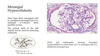 Mesangial
Hypercellularity
More than three mesangial cells
in peripheral mesangial area in a
standard 2–3-micron thick
paraffin section.
The central stalk of the tuft
should not be used for assessing
cellularity.
Thicker sections give an
artefactual impression of
hypercellularity.
(PAS) IgA nephropathy showing mesangial
hypercellularity in which there are ≥ 4 mesangial cells in a
peripheral mesangial area.
 