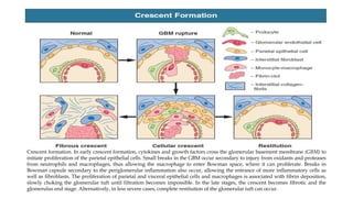 Crescent formation. In early crescent formation, cytokines and growth factors cross the glomerular basement membrane (GBM) to
initiate proliferation of the parietal epithelial cells. Small breaks in the GBM occur secondary to injury from oxidants and proteases
from neutrophils and macrophages, thus allowing the macrophage to enter Bowman space, where it can proliferate. Breaks in
Bowman capsule secondary to the periglomerular inflammation also occur, allowing the entrance of more inflammatory cells as
well as fibroblasts. The proliferation of parietal and visceral epithelial cells and macrophages is associated with fibrin deposition,
slowly choking the glomerular tuft until filtration becomes impossible. In the late stages, the crescent becomes fibrotic and the
glomerulus end stage. Alternatively, in less severe cases, complete restitution of the glomerular tuft can occur.
 