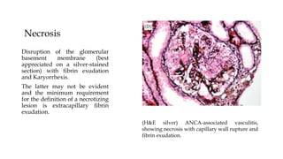 Necrosis
Disruption of the glomerular
basement membrane (best
appreciated on a silver-stained
section) with fibrin exudation
and Karyorrhexis.
The latter may not be evident
and the minimum requirement
for the definition of a necrotizing
lesion is extracapillary fibrin
exudation.
(H&E silver) ANCA-associated vasculitis,
showing necrosis with capillary wall rupture and
fibrin exudation.
 