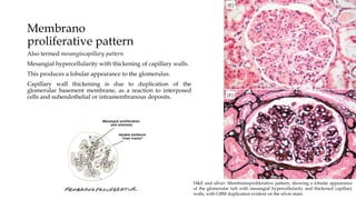 Membrano
proliferative pattern
Also termed mesangiocapillary pattern
Mesangial hypercellularity with thickening of capillary walls.
This produces a lobular appearance to the glomerulus.
Capillary wall thickening is due to duplication of the
glomerular basement membrane, as a reaction to interposed
cells and subendothelial or intramembranous deposits.
H&E and silver: Membranoproliferative pattern, showing a lobular appearance
of the glomerular tuft with mesangial hypercellularity and thickened capillary
walls, with GBM duplication evident on the silver stain.
 