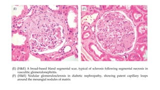 (E) (H&E) A broad-based bland segmental scar, typical of sclerosis following segmental necrosis in
vasculitic glomerulonephritis.
(F) (H&E) Nodular glomerulosclerosis in diabetic nephropathy, showing patent capillary loops
around the mesangial nodules of matrix
 