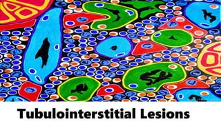 Tubulointerstitial Lesions
 