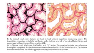 In the normal renal cortex tubules are back to back without significant intervening space. The
interstitium comprises peritubular capillaries and a delicate network of myofibroblasts that are not
appreciated without immunohistochemistry (IH).
(a, b) Normal renal tubules on H&E/silver and PAS stains. The proximal tubules have abundant
eosinophilic cytoplasm. PAS stain demonstrates the brush border on the luminal surface. The tubular
basement membranes are closely apposed with very little interstitium evident.
 