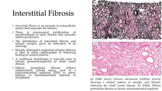 Interstitial Fibrosis
• Interstitial fibrosis is an increase in extracellular
matrix that separates the tubules.
• There is pronounced proliferation of
myofibroblasts in early fibrosis that precedes
matrix production.
• The distribution of interstitial fibrosis and
tubular atrophy gives an indication of its
aetiology.
• Sharply delineated segmental atrophy/fibrosis
is seen in reflux nephropathy or following
healing of cortical infarcts.
• A multifocal distribution is typically seen in
chronic glomerulonephritis or small vessel
disease.
• Diffuse peritubular fibrosis follows
inflammatory tubular injury, such as a
tubulointerstitial nephritis (TIN) in native
kidneys or tubulointerstitial rejection in
transplants
(e) (H&E silver) Chronic calcineurin inhibitor toxicity
showing a striped pattern of atrophy and fibrosis,
reflecting the small vessel disease. (f) (H&E) Diffuse
peritubular fibrosis in chronic tubulointerstitial nephritis.
 