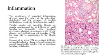 Inflammation
• The significance of interstitial inflammation
depends upon the nature of the cells, their
distribution and the presence of tubulitis
(infiltration of tubules by the inflammatory cells).
• Tubular atrophy and interstitial fibrosis are
usually accompanied by an infiltrate of small
lymphocytes, frequently with lymphoid
aggregates, whatever the aetiology of the chronic
damage; such infiltrates are not a marker of TIN,
but may still be contributing to the fibrotic
process.
• Features of an active TIN are a mixed infiltrate,
frequently including plasma cells and eosinophils,
around non-atrophic tubules with an associated
lymphocytic tubulitis. (a) (H&E) A non-specific infiltrate of small
lymphocytes associated with an area of scarring.
(b) (H&E) Tubulointerstitial nephritis, showing a
mixed interstitial infiltrate of lymphocytes, plasma
cells, eosinophils, and neutrophils.
 