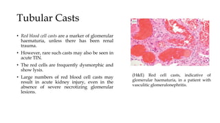 Tubular Casts
• Red blood cell casts are a marker of glomerular
haematuria, unless there has been renal
trauma.
• However, rare such casts may also be seen in
acute TIN.
• The red cells are frequently dysmorphic and
show lysis.
• Large numbers of red blood cell casts may
result in acute kidney injury, even in the
absence of severe necrotizing glomerular
lesions.
(H&E) Red cell casts, indicative of
glomerular haematuria, in a patient with
vasculitic glomerulonephritis.
 