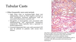 Tubular Casts
• Other frequently seen casts include
• light chain casts in myeloma/light chain cast
nephropathy, which are PAS negative and have a
hard crystalline, fractured appearance with an
associated inflammatory reaction; and
• Myoglobin or haemoglobin casts associated with
rhabdomyolysis and intravascular haemolysis
respectively. These typically have a granular or
beaded appearance.
• Greenish pigmented bile casts with associated ATI
may be present in patients with severe liver
disease.
(B) (PAS) Light chain cast nephropathy, characterized
by PAS-negative fractured casts with associated
inflammation and tubular epithelial injury.
(C) (H&E) Granular eosinophilic haemoglobin casts in
a patient with AKI associated with intravascular
haemolysis.
 