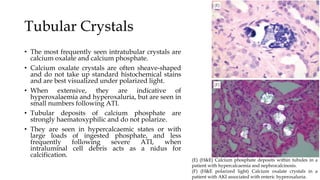 Tubular Crystals
• The most frequently seen intratubular crystals are
calcium oxalate and calcium phosphate.
• Calcium oxalate crystals are often sheave-shaped
and do not take up standard histochemical stains
and are best visualized under polarized light.
• When extensive, they are indicative of
hyperoxalaemia and hyperoxaluria, but are seen in
small numbers following ATI.
• Tubular deposits of calcium phosphate are
strongly haematoxyphilic and do not polarize.
• They are seen in hypercalcaemic states or with
large loads of ingested phosphate, and less
frequently following severe ATI, when
intraluminal cell debris acts as a nidus for
calcification.
(E) (H&E) Calcium phosphate deposits within tubules in a
patient with hypercalcaemia and nephrocalcinosis.
(F) (H&E polarized light) Calcium oxalate crystals in a
patient with AKI associated with enteric hyperoxaluria.
 