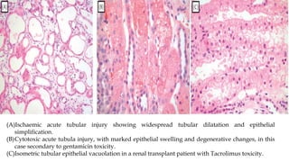 (A)Ischaemic acute tubular injury showing widespread tubular dilatation and epithelial
simplification.
(B)Cytotoxic acute tubula injury, with marked epithelial swelling and degenerative changes, in this
case secondary to gentamicin toxicity.
(C)Isometric tubular epithelial vacuolation in a renal transplant patient with Tacrolimus toxicity.
 