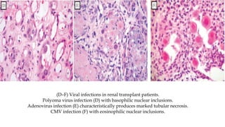 (D–F) Viral infections in renal transplant patients.
Polyoma virus infection (D) with basophilic nuclear inclusions.
Adenovirus infection (E) characteristically produces marked tubular necrosis.
CMV infection (F) with eosinophilic nuclear inclusions.
 