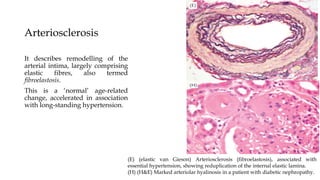 Arteriosclerosis
It describes remodelling of the
arterial intima, largely comprising
elastic fibres, also termed
fibroelastosis.
This is a ‘normal’ age-related
change, accelerated in association
with long-standing hypertension.
(E) (elastic van Gieson) Arteriosclerosis (fibroelastosis), associated with
essential hypertension, showing reduplication of the internal elastic lamina.
(H) (H&E) Marked arteriolar hyalinosis in a patient with diabetic nephropathy.
 