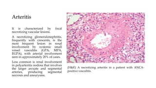 Arteritis
It is characterized by focal
necrotizing vascular lesions.
A necrotizing glomerulonephritis,
frequently with crescents, is the
most frequent lesion in renal
involvement by systemic small
vessel vasculitis (GPA, MPA,
EGPA), with arterial involvement
seen in approximately 20% of cases.
Less common is renal involvement
in polyarteritis nodosa that involves
the larger arcuate and segmental
arteries, producing segmental
necrosis and aneurysms.
(H&E) A necrotizing arteritis in a patient with ANCA-
positive vasculitis.
 