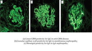 (a) Linear GBM positivity for IgG in anti-GBM disease.
(b)Granular capillary wall positivity for IgG in membranous nephropathy.
(c) Mesangial positivity for IgA in IgA nephropathy.
 