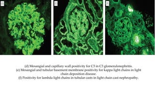 (d) Mesangial and capillary wall positivity for C3 in C3 glomerulonephritis.
(e) Mesangial and tubular basement membrane positivity for kappa light chains in light
chain deposition disease.
(f) Positivity for lambda light chains in tubular casts in light chain cast nephropathy.
 