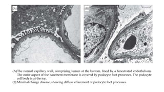 (A)The normal capillary wall, comprising lumen at the bottom, lined by a fenestrated endothelium.
The outer aspect of the basement membrane is covered by podocyte foot processes. The podocyte
cell body is at the top.
(B) Minimal change disease, showing diffuse effacement of podocyte foot processes.
 