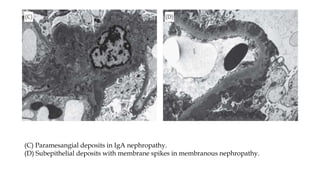 (C) Paramesangial deposits in IgA nephropathy.
(D) Subepithelial deposits with membrane spikes in membranous nephropathy.
 